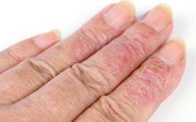 What Is Eczema?