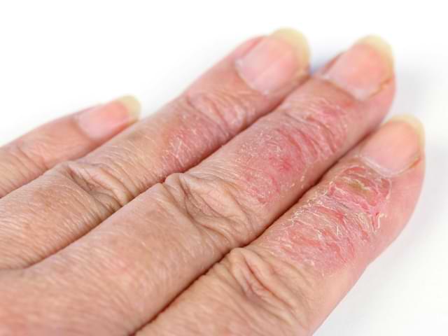 eczema hands dry skin
