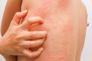 Eczema,Skin rashes,Hives (urticaria)
