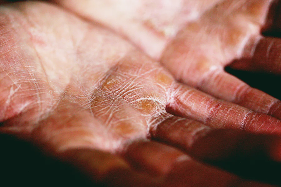 hands with urticaria